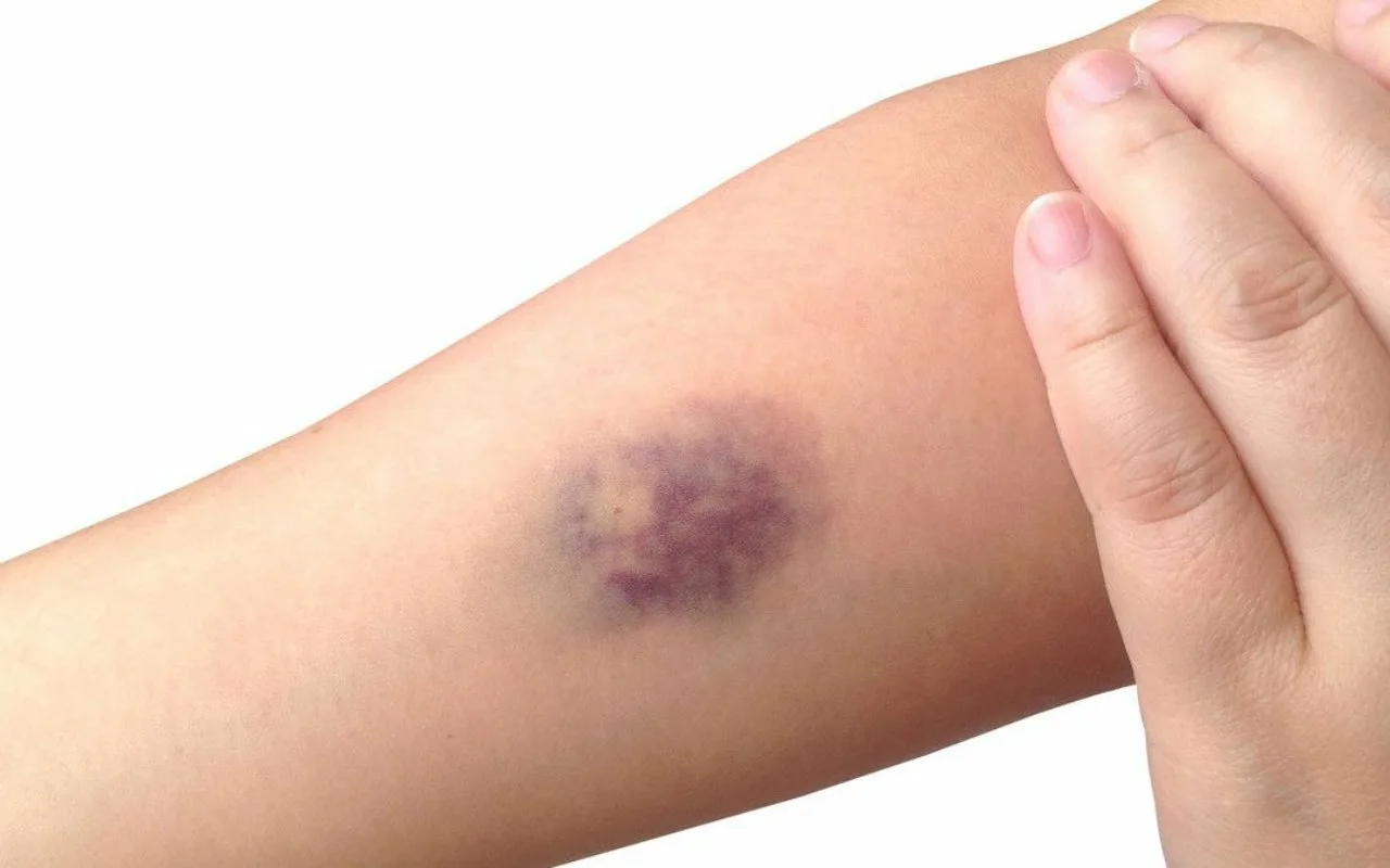 Balinātājs Tiem Kaitē, Etiķis Nav Pietiekams: Šeit Ir Brīnumains Mājas Pagatavots Gēls, Kas Patiešām Ir Efektīvs Jūsu Tumšajiem Savienojumiem!